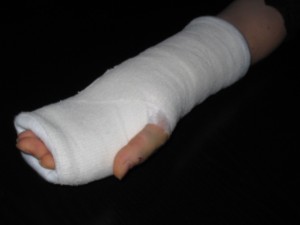 Hand_in_gips